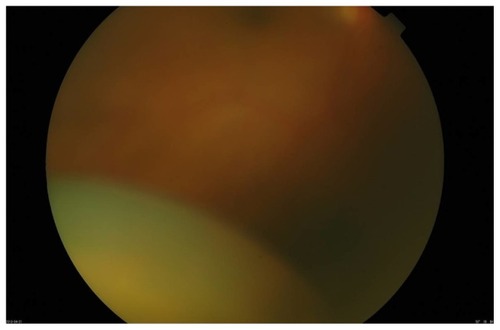 Figure 3 Preoperative ocular fundus examination of the right eye. The lens has been displaced into the vitreous cavity.