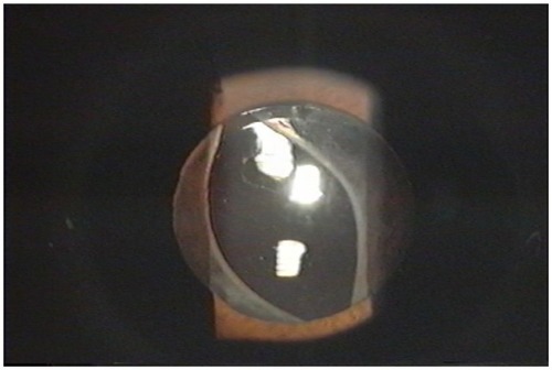 Figure 2 Slit-lamp photograph at 12 months postoperatively.