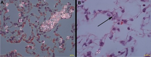 Figure 3 Polarizing properties of SPION microbubbles. Single and clustered SPION microbubbles in pulmonary vasculature and macrophages (10 minutes post injection) show birefringent walls when viewed using polarized light (A). At 3 weeks post injection, a decrease in birefringence is shown in phagocytosed SPION microbubbles [arrow, (B)]. The size bar represents 10 μm.Abbreviation: SPION, superparamagnetic iron oxide.