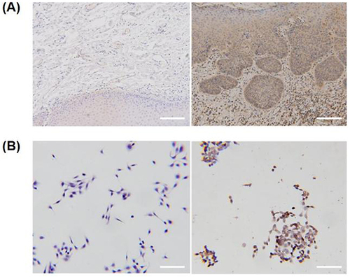 Figure 3 FAP is highly expressed in OSCC. (A) Representative immunohistochemistry images of FAP staining in normal and OSCC tissues. Scale bar: 100 µm. (B) Representative immunohistochemistry images of FAP staining in HOK and CAL-27 cells. Scale bar: 50 µm.