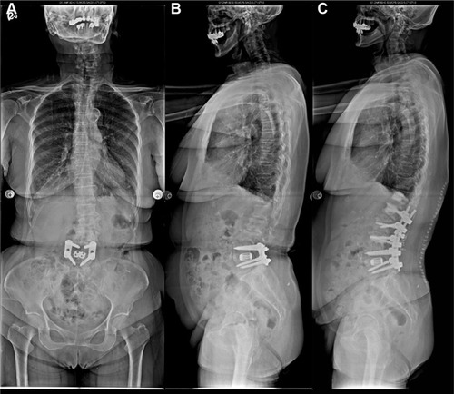 Figure 1 (A and B) Standing radiographs (anteroposterior and lateral view) showing degenerative disc change with retrolisthesis of L2-L3 and L3-L4; (C) the first immediately postoperative radiograph after instrumented fusion from L1 to L5 with cement augmentation of T12 and L1.
