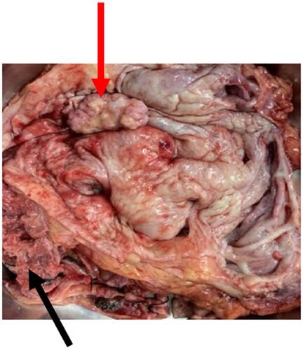 Figure 2 Grossly, the tumor appeared as exophytic, cauliflower-shaped like mass in the right renal pelvis (3.5×2.5×2.0 cm3) (red arrow); at the ureteropelvic junction, there was another tumor with invasive growth that caused an obstruction of ureter (black arrow).