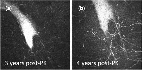 Figure 2. Regeneration of subbasal nerves following penetrating keratoplasty (PK) as documented by in vivo confocal microscopy in the same corneal region 3 and 4 years postoperatively. (a) After 3 years, only a single regenerated nerve is visible in this region, following a path around the peripheral postoperative scar tissue (hyper-reflective white region). (b) One year later upon examination of the same scar feature, increased nerve regeneration was apparent with nerve paths differing over time, indicative of continuous axonal growth and regeneration. Image size is 400 x 400 µm.