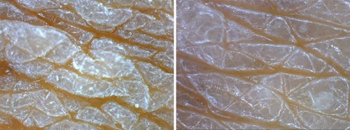 Figure 4 High resolution of dermascope view (100×). Before treatment, the skin was rough and chapped with keratinization (left panel). Skin roughness improved and looked smooth with less keratinization on the surface (right panel).