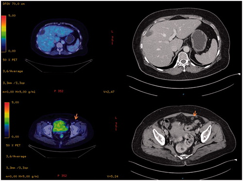 Figure 4. A case of non-FDG avidity in mucinous adenocarcinoma. The diagnosis of hepatic lesion and left hemipelvis nodule reported as indeterminate on CT scan remained unknown even after PET-CT was done.