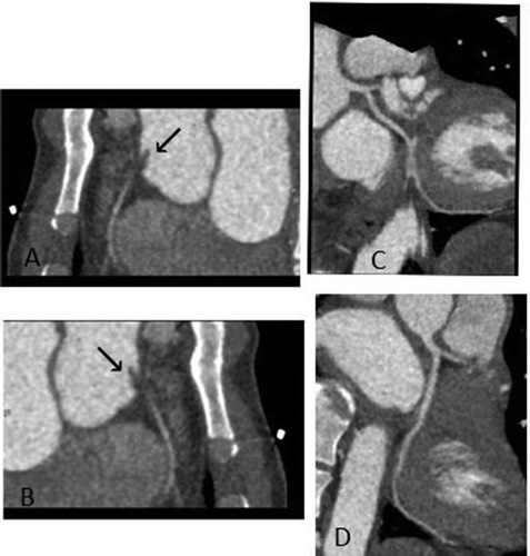 Figure 2. Coronary CTA showing a filling defect at the right coronary sinus (black arrow) at the level of the right coronary artery ostium suggesting thrombus occluding the proximal right coronary artery (A, B) and normal left coronaries (C,D)