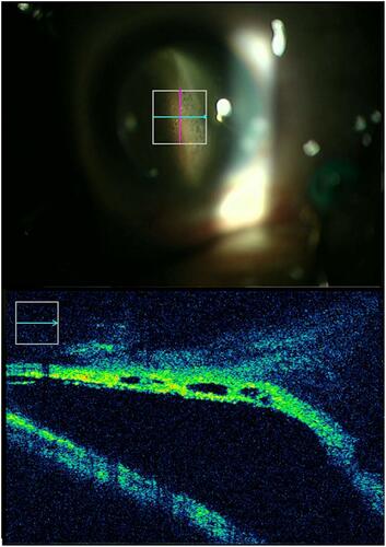 Figure 2 Peripheral cystoid degeneration in detached retina assessed by intraoperative optical coherence tomography (a 49-year-old-female).
