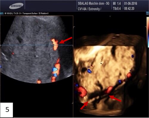 Figure 5. Gray-scale and 3D ultrasound with Power Doppler: multiple images of placenta accreta with bridging vessels on Color Doppler; loss of regularity and interruption of uterine serosa bladder face, demonstrated on 3D. (red arrow).