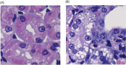 Figure 1. HE staining. (A) No abnormal changes were detected in the Sham group. (B) In the UUO group, tubular edema appeared and inflammatory cell infiltrated in renal interstitium.