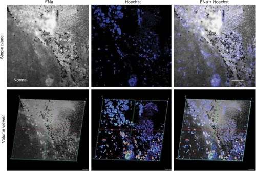 Figure 2 2D (top) and 3D (bottom) LSM images of the same field of view showing the glioma border in mouse brain tissue. FNa was given intraoperatively, and the specimen was counterstained with Hoechst immediately ex vivo. Confocal images show higher signals of fluorescence within the tumor area with visible contours of individual tumor cells. Some of the tumor cells absorbed FNa, whereas others did not and appear darker than surrounding background. RBCs appear as hypointense areas of darkening. Hoechst stain provides visualization of nuclei and does not appear fluorescent within areas that represent the locations of RBCs. Overlapping the two images helps to confirm and reduce uncertainty between the individual characterizations of tumor versus RBCs. The lower row of images represents the 3D-reconstruction volume viewer images that were compiled using images obtained from a Z-stack. The images are angulated to help visualize the 3D nature of the image. Scale bar is 50 µm.Note: Used with permission from Barrow Neurological Institute.Abbreviations: 2D, two-dimensional; 3D, three-dimensional; FNa, fluorescein sodium; LSM, laser scanning microscope; RBC, red blood cell.