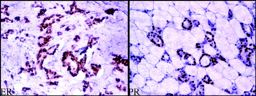 Figure 2. Expression of oestrogen receptors (ER) and progesterone receptors (PR) in cancer tissue visualized by immunohistochemistry.