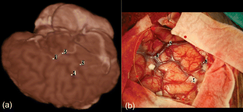 Figure 6. Clinical evaluation: landmarks used to align the two images initially. (a) Landmarks defined on the volume-rendered image. (b) Landmarks defined in the 2D photographic image.