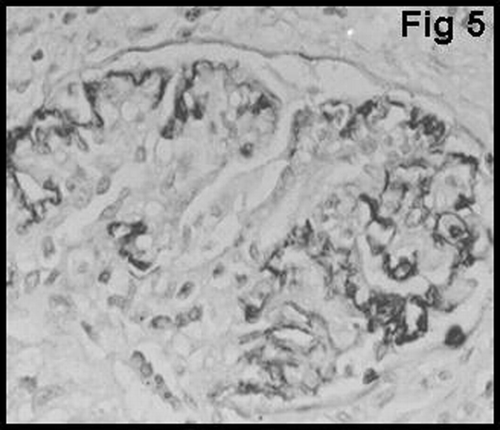 Figure 5 Both subendothelial and segmental mesangial vWF staining were observed in the glomerulus.