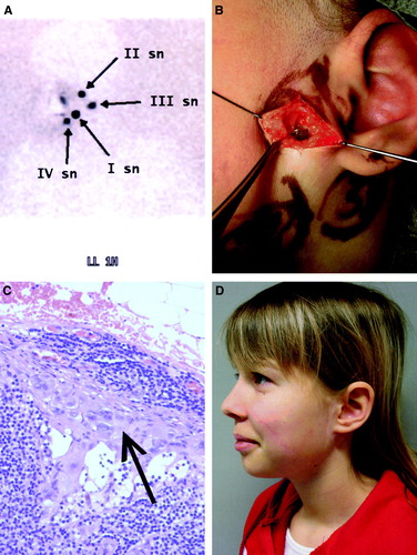 Figure 1.  1A. A lymphoscintigram with four sentinel nodes of an 11-year-old girl with a melanoma in the middle of the left cheek. The primary lesion (Breslow depth 3.8 mm, Clark level IV) had originated in a benign Spitz nevus. 1B. A blue-stained sentinel node (II sn) found in the parotid gland. At the same time of SNB, the biopsy scar of the primary lesion was excised with 1.5 cm lateral margins and the wound was closed directly. 1C. Histopathological analysis (hematoxylin and eosin staining) revealed a subcapsular micrometastasis with minimal tumour burden. It was the only metastatic sentinel node. In a second stage operation, superficial parotidectomy and selective neck dissection of levels II–III were performed and no additional metastatic nodes were detected. 1D. Aesthetic result two years after the operation. The patient has remained disease-free after a follow-up of 27 months.