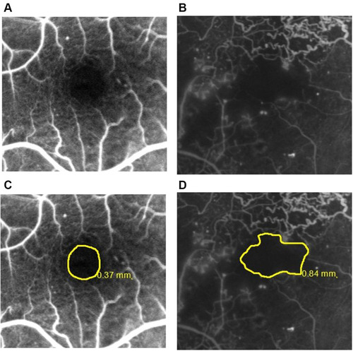 Figure 1 Representative fluorescein angiograms with FAZ outlines: (A) grade ≤2; (B) grade ≥3 according to the ETDRS report number 11.Citation15 The same angiograms with FAZ area boundaries and sizes: (C and D).