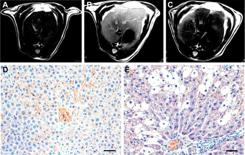 Figure 9 T2-weighted MR images of liver: (A) stage I, normal liver, (B) stage II, acute hepatic injury which is 4 h after CCl4 gavage, and (C) stage III, with the contrast enhancement of the HAp-ION-90 nanoworm. Histochemical analysis of (D) normal hepatic area and (E) injured hepatic area. All scale bars: 20 μm. Reproduced from Xu YJ, Dong L, Lu Y, et al. Magnetic hydroxyapatite nanoworms for magnetic resonance diagnosis of acute hepatic injury. Nanoscale. 2016;8(3):1684–1690 with permission of The Royal Society of Chemistry.Citation76Abbreviations: MR, magnetic resonance; HAp, hydroxyapatite; i, Stage I; ii, Stage II; iii, Stage III.