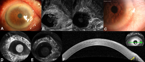 Figure 3 Three-year follow-up of case 6, a 74-year-old-female patient who had primary ocular surface squamous neoplasia in the right eye (A), with sea fan-shaped intratumoral vessels((B) left image: fluorescein angiography; right image: indocyanine green angiography [ICGA]), at baseline. Anterior segment photography (C) reveals that there is no recurrent mass on the corneal surface, and that a pterygium is growing into the corneal limbus between 3 and 6 o’clock. Early- and late-phase indocyanine green angiography reveals perfusion of new vessels in the lower nasal part of the corneal limbus, with no intratumoral or conjunctival feeding vessels (D and E). Anterior segment optical coherence tomography (AS-OCT; F) reveals normal corneal structures and the pterygium growing into the corneal limbus between 3 and 6 o’clock (green arrow indicates the direction of AS-OCT scanning). The latter is visible as a thickened, highly reflective lesion between the corneal epithelium and Bowman’s membrane in the subepithelial space (yellow arrow).