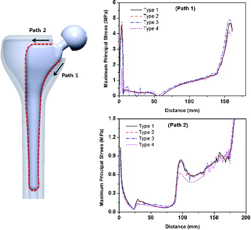 Figure 3. Maximum principal stress distribution along the bone–implant interface under a constant loading of 1750 N.