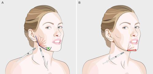 Figure 16 Injection points for jawline rejuvenation with non-traumatic cannula. (A) Mandibular angle entry point; (B) Pre-jowl sulcus entry point. Schematics © Dr. Jani van Loghem.