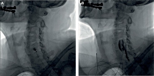 Figure 1 Fluoroscopic view of stellate ganglion block before and after the administration of contrast agent.