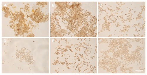 Figure 9 In situ polymerase chain reaction (ISPCR) on samples that were incubated with nanobarcoded superparamagnetic iron oxide nanoparticles at (A) 200 nM, (B) 50 nM, (C) 25 nM, or (D) 0 final concentrations for 24 hours. The same ISPCR cocktail (containing reverse primer and template) was used for these samples. Control ISPCR samples were performed with (E) human papilloma virus 18 E7 primers or (F) water.Note: Scale bar is 100 μm.