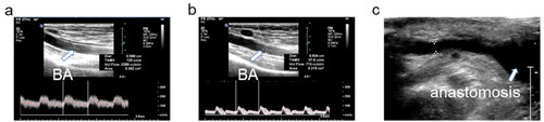 Figure 3. The changes in volume flow of the brachial artery before (a) and after (b) NILLINR operation. BA: brachial artery.