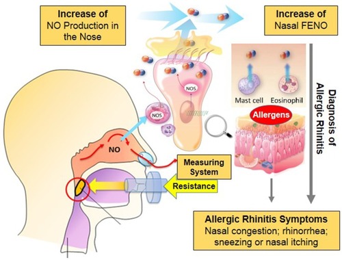 Figure 2 Origin of nasal NO and technique of nNO measurement. Exhaled NO is produced from the epithelial cells, eosinophils, mast cells, and other cells under the activity of iNOS during contact with allergens. The measurement of nNO is done by introducing the sampling catheter to the nasal cavity via the nostril to aspirate the internal air stream.