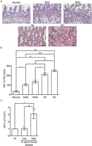 Figure 1. HIF-1α is associated with more advanced disease in humans. HIF-1α IHC was quantified in patients with normal gastric mucosa (N = 6), non-atrophic gastritis (NAG, N = 8), multifocal atrophic gastritis (MAG, N = 10), intestinal metaplasia (IM, N = 13), and gastric cancer (GC, N = 10) (a-b). Representative IHC images are shown at 200X and scale bars represent 100 µm (a). AGS cells were co-cultured with H. pylori clinical isolates from low-risk (N = 9) or high-risk (N = 9) patients and HIF-1α expression was assessed by qRT-PCR (c). ANOVAs with Sidak multiple comparisons test (b-c) were used for statistical analyses and standard error of the mean is shown. ****, P < .0001; ***, P < .001; **, P < .01; *, P < .05.