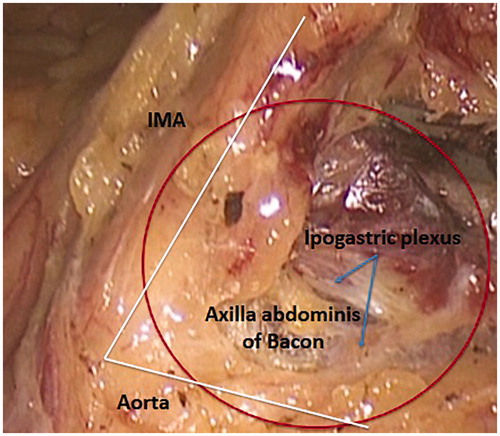 Figure 9. The angle between IMA and the anterior aspect of the aorta is defined as the axilla abdominis of Bacon.