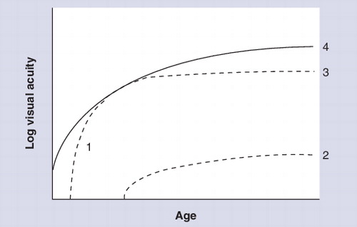 Figure 1. Schematic representation of acuity development in delayed visual maturation.In delayed visual maturation (DVM) type I, visual acuity improves rapidly and returns to normal (line 1 connecting to line 4). In DVM type III, visual acuity also improves rapidly but returns to near-normal (line 1 connecting to line 3). In DVM types II and IV visual acuity is late to improve and remains impaired (line 2).Reproduced with permission from Citation[42].