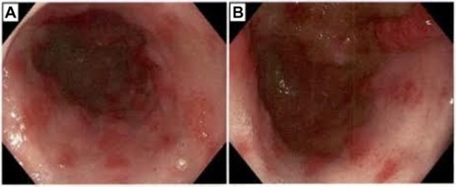 Figure 1 Gastric antral vascular ectasia on initial upper endoscopy.