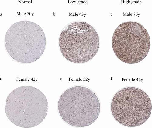 Figure 7. HOXA4 protein expression in tissues according to the immunohistochemistry analysis of data obtained from the Human Genome Atlas database. Protein expression (a, d) in normal tissue, (b, e) in low-grade glioma tissue, and (c, f) in high-grade glioma tissue.