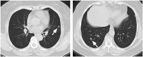Figure 2. Female patient 66 with bilateral lung metastases after rectal cancer surgery (arrow).