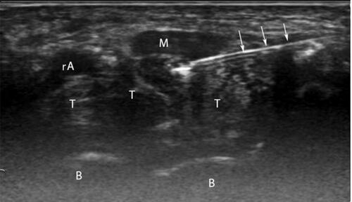 Figure 2 Ultrasound-guided injection inside the carpal tunnel from ulnar side in transverse (short axis) view (M, median nerve; T, tendons; B, carpal bones; rA, radial artery; white arrows, needle).