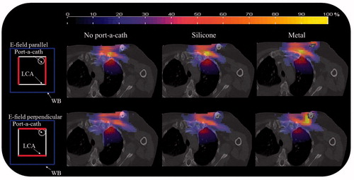 Figure 4. Predicted SAR distributions for set-up A, location 2 (schematically shown on the left) and E-field directions perpendicular and parallel to the body axis. Colour wash SAR distributions are for no port-a-cath (i.e. the control distribution with the port-a-cath replaced by fat tissue), the silicone port-a-cath, and the metal port-a-cath.