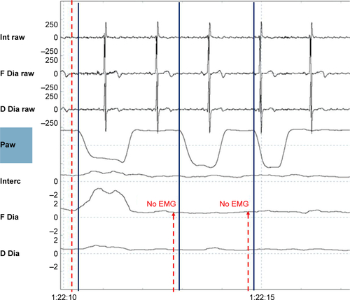 Figure S5 Autotriggering.Notes: Shown are (from top to bottom) the raw intercostal signal (Int raw), the raw frontal diaphragm signal (F Dia raw), the raw dorsal diaphragm signal (D Dia raw), the pressure wave (Paw), the average intercostal signal (Interc), the average frontal diaphragm (F Dia) signal, and the average dorsal diaphragm signal (D Dia). During this low-frequency setting (backup frequency 10 breaths/min), the two breaths denoted by arrows come too soon to be PC. As it is not preceded by EMG activity, these are defined as inappropriate autotriggered breaths (straight blue lines).Abbreviations: EMG, electromyography; PC, pressure-controlled.