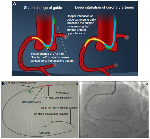 Figure 9 Extra backup support by using “mother-child” catheters concept.