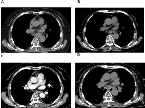 Figure 2 Chest CT scans during therapy. (A) SCCE relapsed after six courses of IP chemotherapy. (B) Esophageal wall shrinkage after 1 month of anlotinib monotherapy. (C) Esophageal wall re-thickening after 3 months of anlotinib monotherapy. (D) After 3 months of treatment with anlotinib in combination with toripalimab.