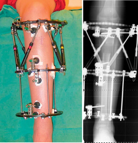 Figure 1. Tibial lengthening by use of proximal metaphyseal osteotomy and application of the Taylor spatial frame with an additional distal Ilizarov ring. Clinical view (A) and standing radiograph (B). The images were taken 3 weeks after end of distraction (10 weeks postoperatively). They show parallel rings and a lengthening of 43 mm.