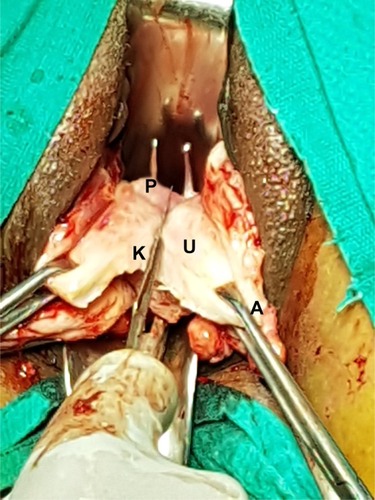 Figure 8 The uterine wall (U) was divided by a surgical knife (K) between the prongs (P) of the right angle forceps. Alli’s forceps (A).