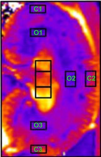 Figure 4 Selection of regions of interest. C 1–3 identify cortical regions of interest. O 1–3 identify outer medullary regions of interest.