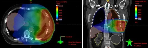 Figure 3 Image of radiotherapy planning from the SYSTEM-2 study, illustrating the typical dose distribution.