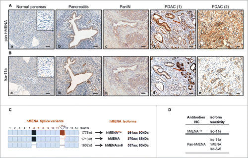 Figure 1. (A) Pattern of hMENA isoform expression in human pancreatic ductal carcinogenesis. Representative immunohistochemical staining with pan hMENA and (B) Iso-11a in normal pancreas (a), chronic pancreatitis, (b), PanIN-3 (c), and PDAC (d and e). Red arrows indicate strong staining in non-neoplastic pancreatic ducts adjacent to the tumor. Magnification 10X, Scale Bar = 100 µm (a, b, c, d); Magnification 20X, Scale bar = 30 µm (e). (C) Schematic representation of human hMENA transcripts and isoforms evaluated: hMENA and the two alternatively expressed hMENA11a and hMENAΔv6. (D) hMENA antibodies used in the immunohistochemical analysis.