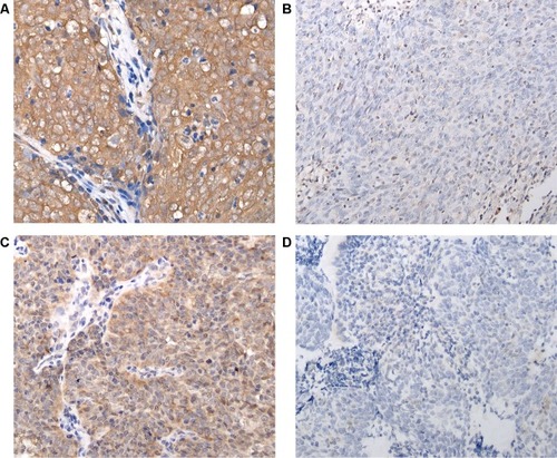 Figure 1 Immunostaining of TIGAR and LC3B protein expressions in nasopharyngeal carcinoma.Notes: (A) TIGAR+ (×200); (B) TIGAR− (×200); (C) LC3B+ (×200); (D) LC3B− (×200).Abbreviations: LC3B, microtubule-associated protein 1 light chain 3; TIGAR, TP53-induced glycolysis and apoptosis regulator.