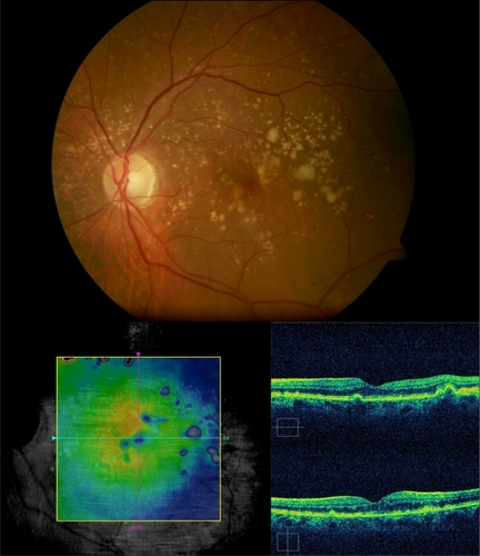 Figure 2 Subject 3: Final visit. Retinal pigment epithelium returned to a normal contour and no fluid was evident within the retina 66 weeks after a single injection of intravitreal ranibizumab (top and bottom). Best-corrected visual acuity improved to 20/20 and remained stable through the follow-up period. No visual complaint was referred.
