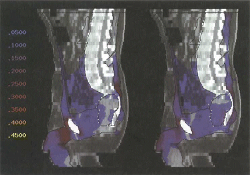Figure 5. Power distribution (sagittal section, colourwash representation) after optimisation with Θ2 for tumour model 1 (high presacral), using the commercially available SIGMA-60 applicator (left). Hot spots at the dorsal sacral bone and at the symphysis. Only little power in the tumour. The power distribution using the upgraded triple-ring applicator (24 antennas according to Figure 1) is shown on the right. Hot spots are considerably reduced. Power in the tumour is clearly increased. Numbers on the left represent percentages of the maximum of the power distribution, corresponding to different colours.