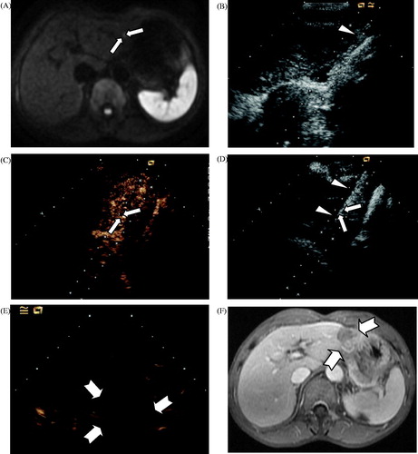 Figure 3. Contrast-enhanced ultrasound (CEUS)-guided MWA in a 62-year old man with primary liver cancer in the vicinity of the LMA. (A) Diffusion-weighted imaging obtained before ablation revealed a small hyperintense area in the left lateral segment (long arrow). (B) The injection of normal saline to separate the liver margin and the stomach wall (arrowhead). (C) Intraoperative CEUS revealed hyper-enhancement (long arrow). (D) US obtained before ablation indicates that the MWA antenna (arrowhead) was placed in the right lateral margin of the target lesion (long arrow). (E) CEUS obtained 6 days after ablation revealed no enhancement (swallowtail arrow). (F) A follow-up contrast magnetic resonance imaging obtained 6 months after ablation displayed no enhancement in the ablation zone of the entire LMA (swallowtail arrow).