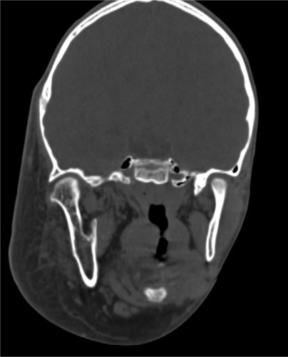 Figure 3 CT scan showing the enlarged right mandible.
