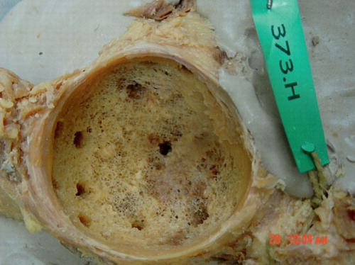 Figure 2. Prepared cadaveric acetabular bone bed with the cancellous bone exposed.