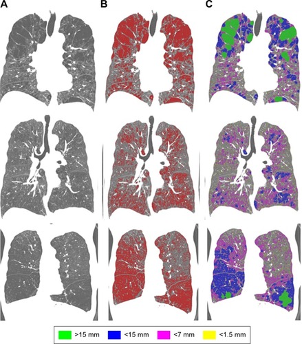 Figure 2 Results of the size-based emphysema clusters of COPD patients.